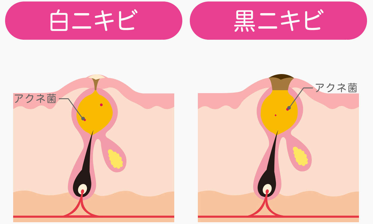 黒い吹き出物（ニキビ）の正体とは？詳しく知らなかった原因からケア方法までしっかり解説 異性目線でのモテるヘアメイク【パトリック大阪】